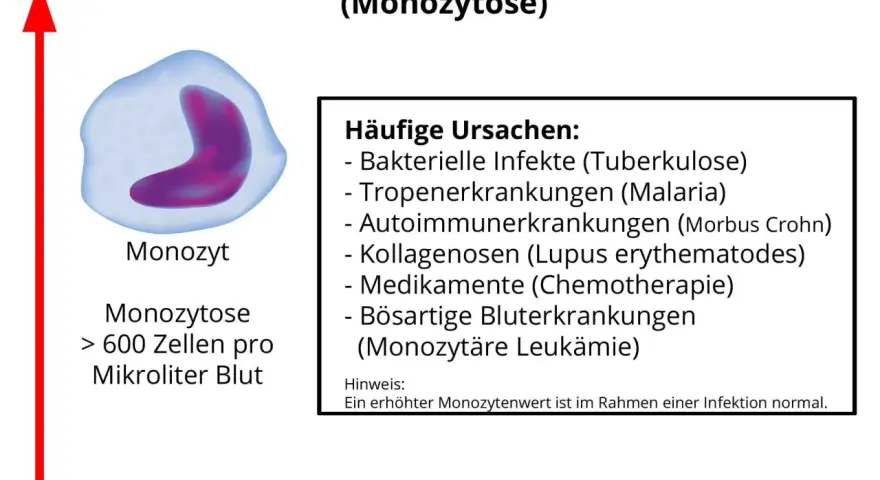 Erhöhte Monozyten (Monozytose) können auf Infektionen, Autoimmunerkrankungen oder Leukämie hinweisen. Der Normwert liegt bei 285-500 Zellen/µl.