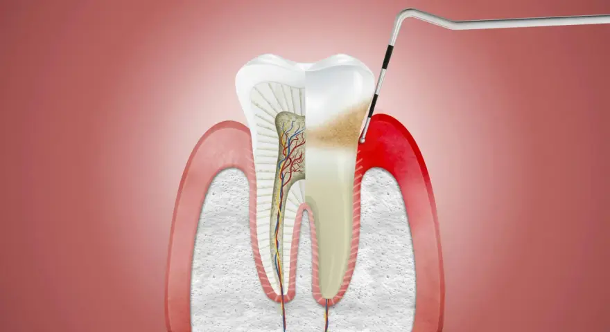 Przekrój zęba z widocznymi naczyniami krwionośnymi i nerwami. Narzędzie dentystyczne bada obszar, gdzie może pojawić się drętwienie dziąseł.