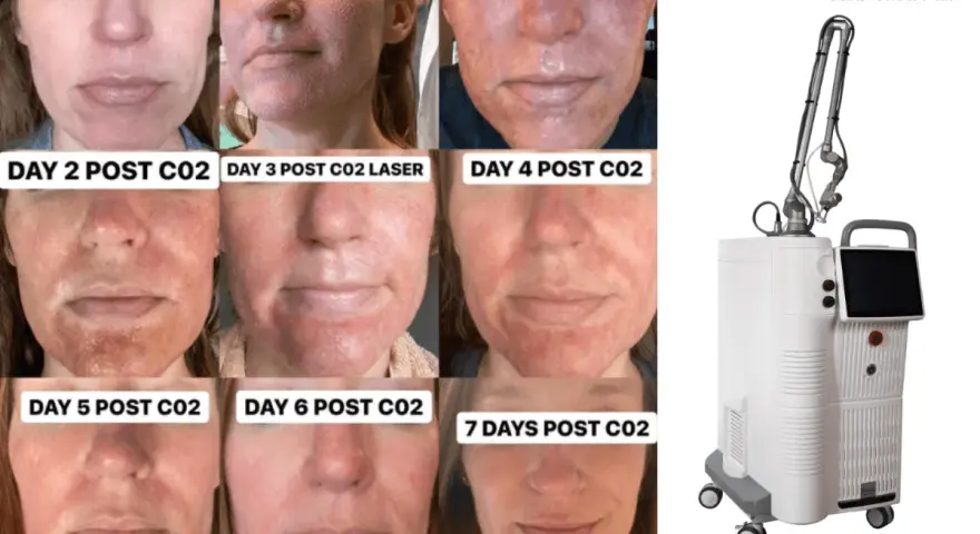 Postępy po zabiegu laserem CO2: od zaczerwienienia do wygojenia skóry w ciągu 7 dni. Obok urządzenie do laseroterapii.