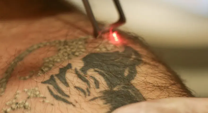 Laser usuwanie tatuażu. Czerwony promień lasera rozjaśnia ciemny wzór na skórze, rozpoczynając proces usuwania tatuażu.