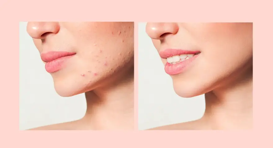 Prima e dopo: pelle con imperfezioni e poi pelle liscia e luminosa, mostrando la trasformazione dopo il processo di skin purging.