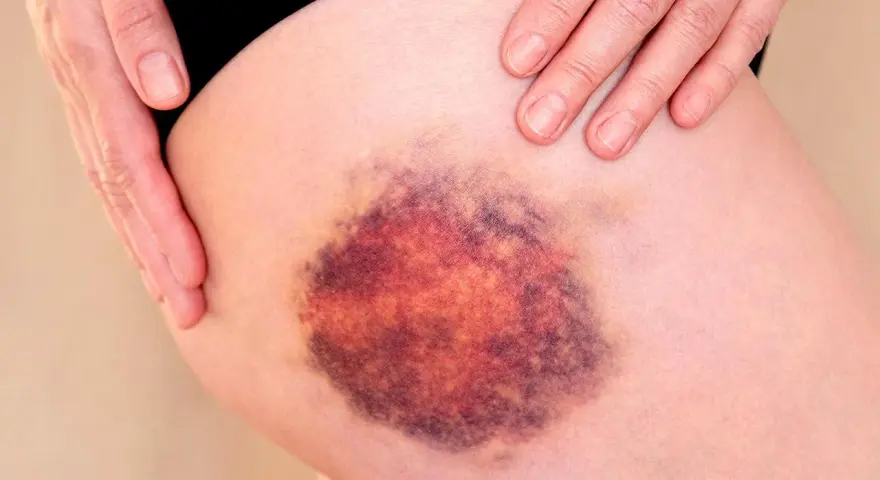 Große, dunkle blaue Flecken auf der Haut des Oberschenkels, die von einer Hand berührt werden.