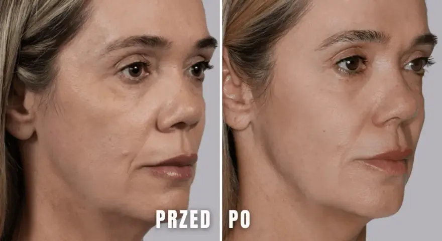 Przed i po zabiegu juvelook pod oczy. Skóra wokół oczu wygładzona, zmarszczki zredukowane.