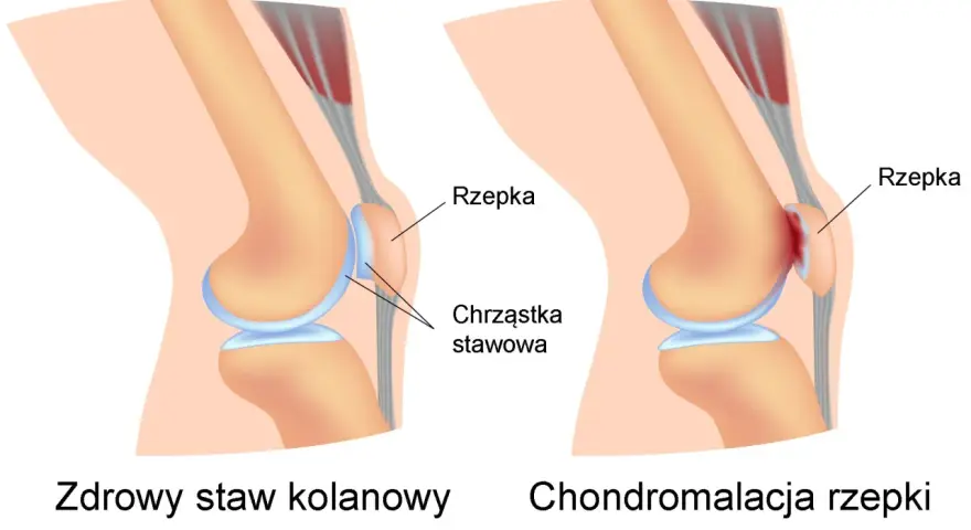 Porównanie zdrowego stawu kolanowego z chondromalacją rzepki, gdzie chrząstka stawowa jest uszkodzona.