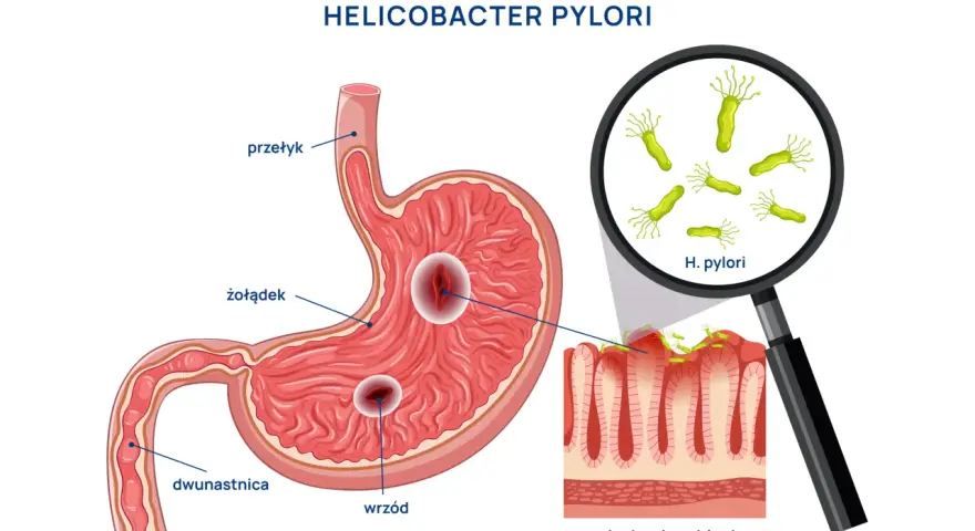 Helicobacter pylori powoduje wrzody żołądka i dwunastnicy, uszkadzając nabłonek.
