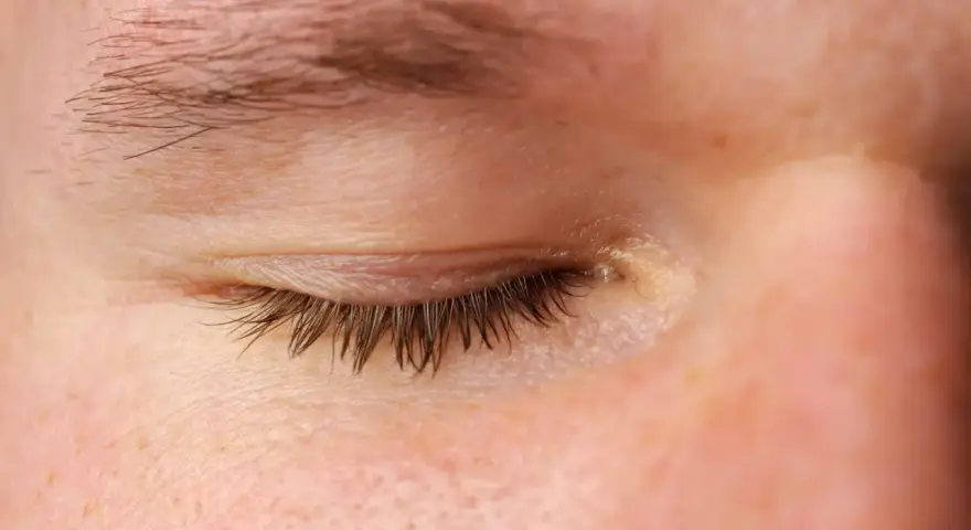 Ojo cerrado con pestañas oscuras y piel con leve grasa en los párpados.