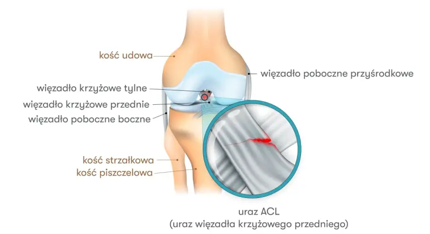 Anatomia kolana z zaznaczonym urazem ACL (przedniego więzadła krzyżowego). Widoczny pęknięty włókna więzadła.