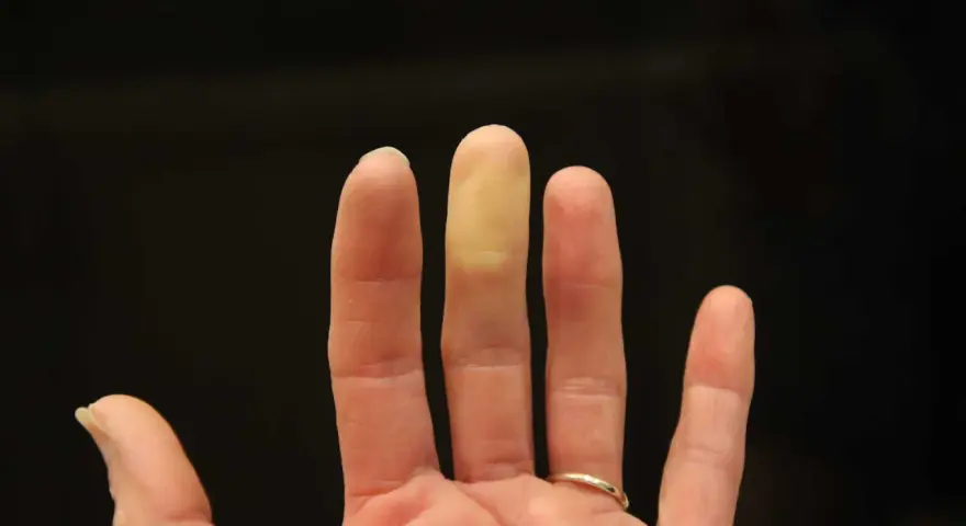 En hand med en gulnad fingertopp, som om den fryser. Kan vara ett tecken på kaloriunderskott.