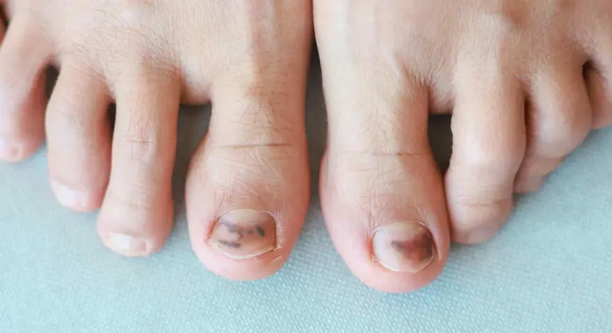 Dita dei piedi con unghie maculate marroni, forse a causa di un trauma o un fungo.