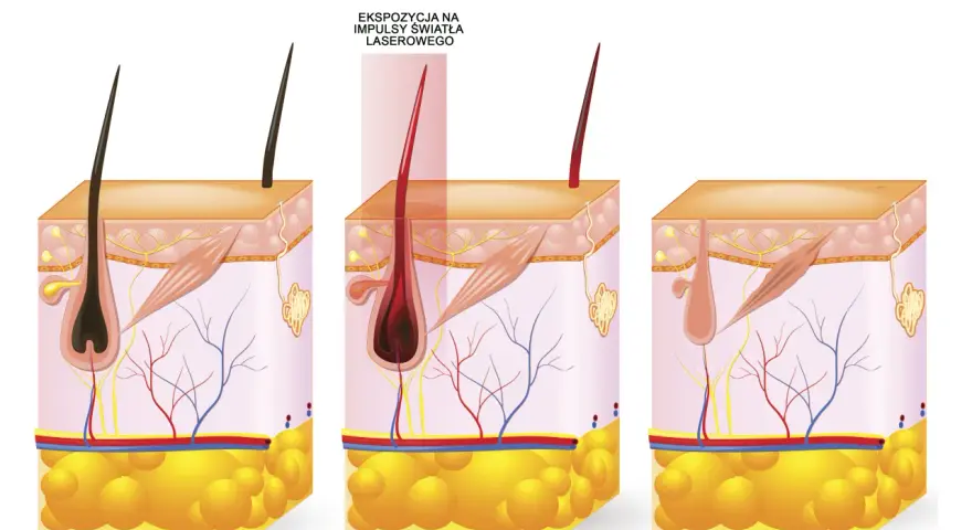 Ilustracja pokazuje laserowe usuwanie wąsika: przed zabiegiem, ekspozycję na laser i efekt po.