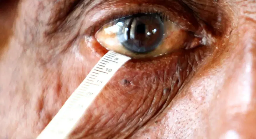 Misurazione della lacrimazione per un test occhio secco. La scala indica la quantità di liquido lacrimale.