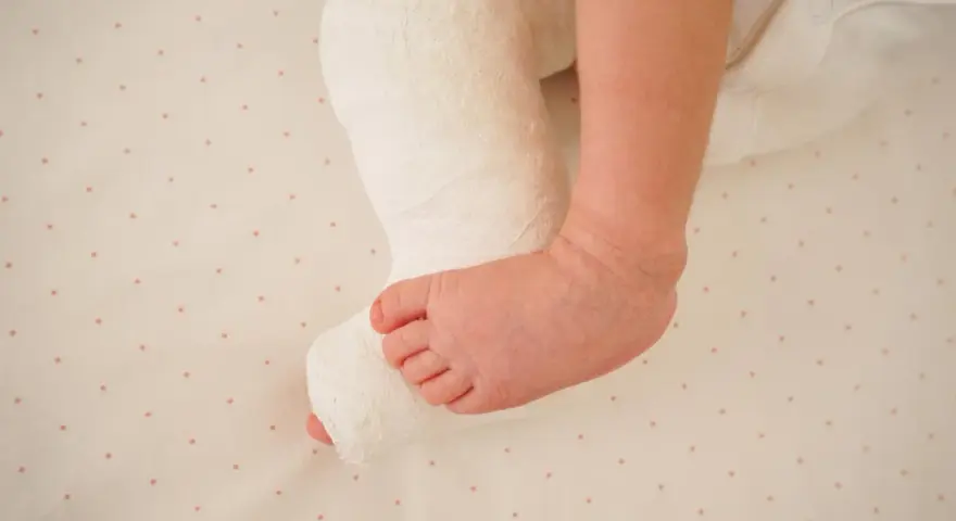 Noga dziecka w gipsie, z widoczną stopą. Leczenie końsko szpotawa u dorosłych wymaga cierpliwości, ale u maluchów rehabilitacja jest kluczowa.