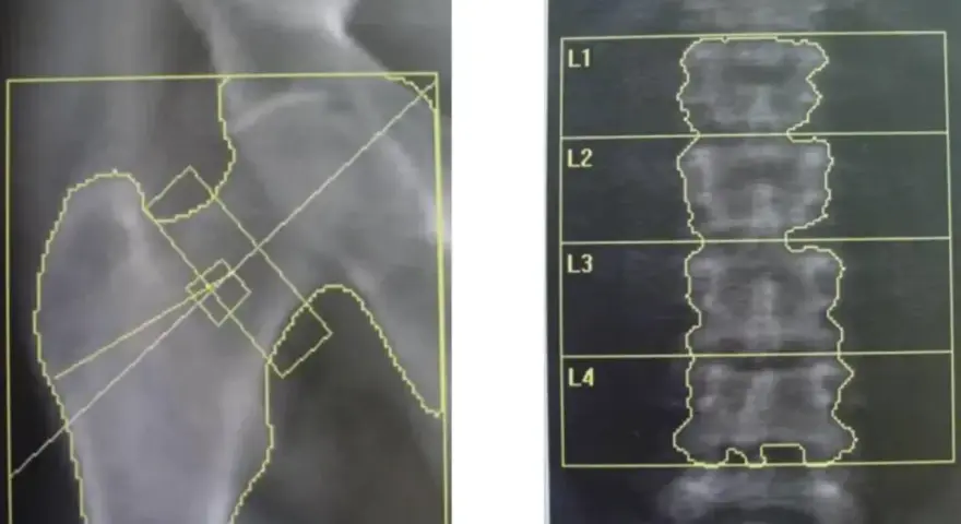 Badanie na osteoporozę: RTG biodra i kręgosłupa lędźwiowego z zaznaczonymi obszarami do analizy.