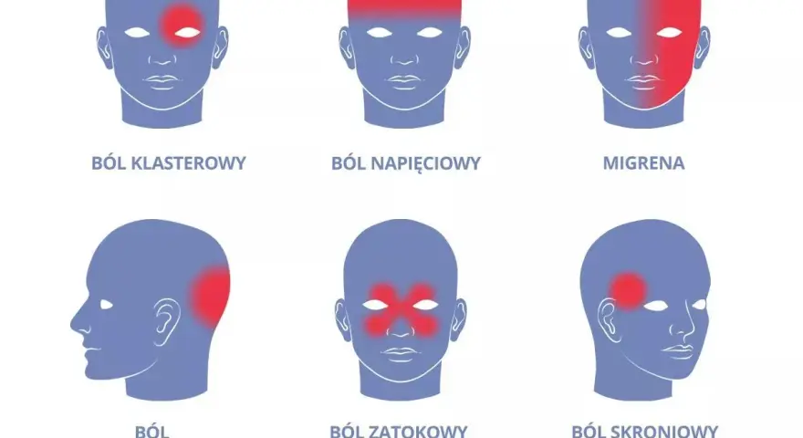 Ilustracja pokazuje różne rodzaje bólu głowy: klasterowy, napięciowy, migrenę, szyjnopochodny, zatokowy i skroniowy.