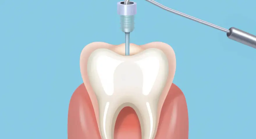 Ilustracja zęba z narzędziem dentystycznym w środku.