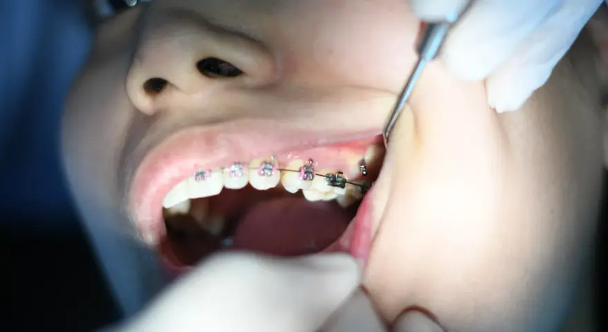 Dziecko z aparatem ortodontycznym, któremu dentysta czyści zęby. Irygator zamiast nici ułatwia higienę.