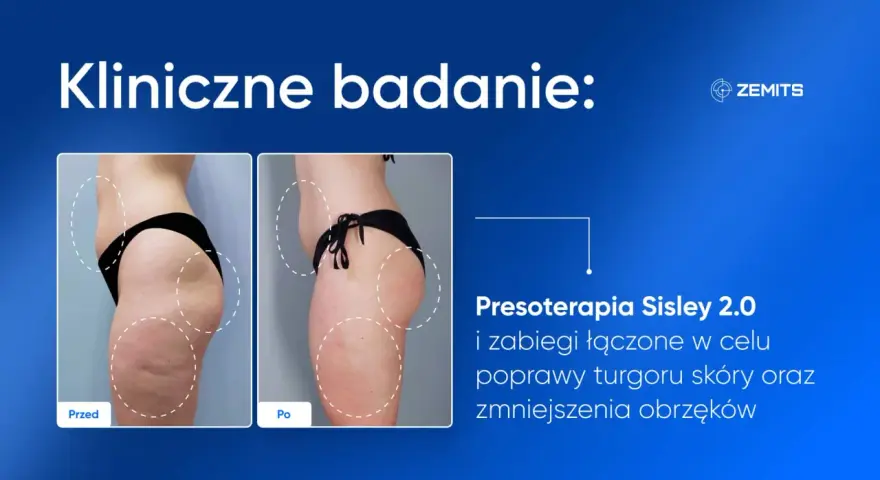 Przed i po zabiegu presoterapii. Widoczne wyraźne presoterapia efekty: poprawa jędrności skóry i redukcja obrzęków.