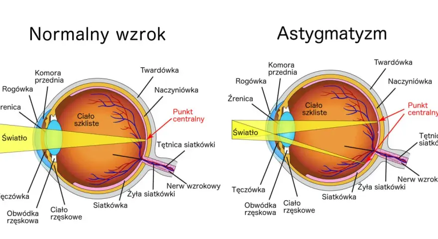 Schemat oka z normalnym wzrokiem i astygmatyzmem, pokazujący drogę światła.