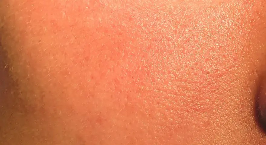 Pelle arrossata e secca, con piccole scaglie visibili, tipica di un'irritazione da retinolo.