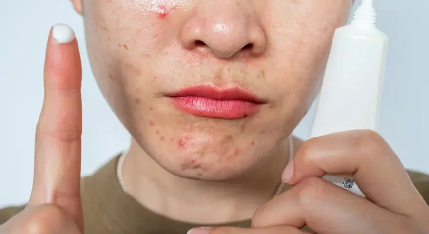 A person's face shows acne and redness, possibly from retinol burn. A finger with cream and a tube of skincare product are visible.