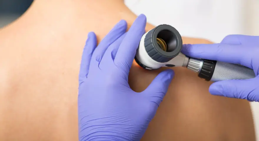 Dermatolog bada dużą ilość pieprzyków na plecach pacjenta za pomocą dermatoskopu.