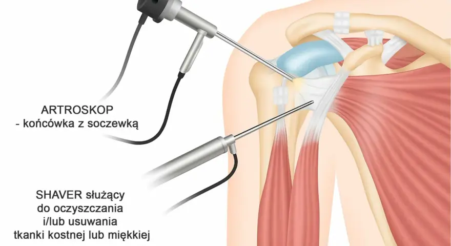 Artroskop i shaver w trakcie zabiegu barku, pomagające w diagnostyce i leczeniu bolesnego łuku.