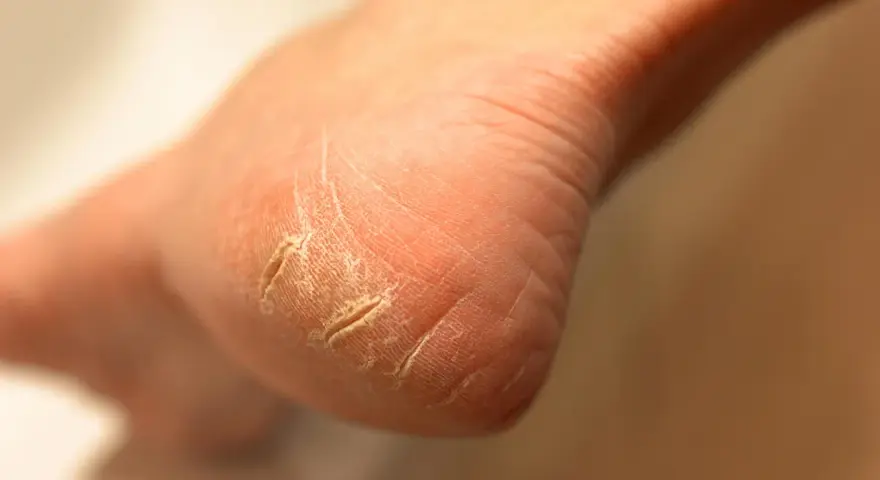 Gros plan sur un talon qui pele, la peau sèche et craquelée formant des sillons profonds.