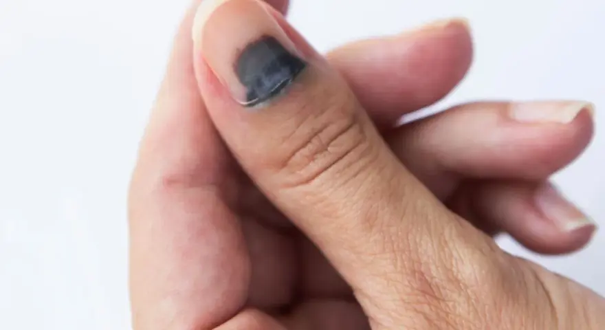 Gros orteil avec un hématome sous l'ongle, signe d'un traumatisme. La zone sombre indique le sang accumulé.