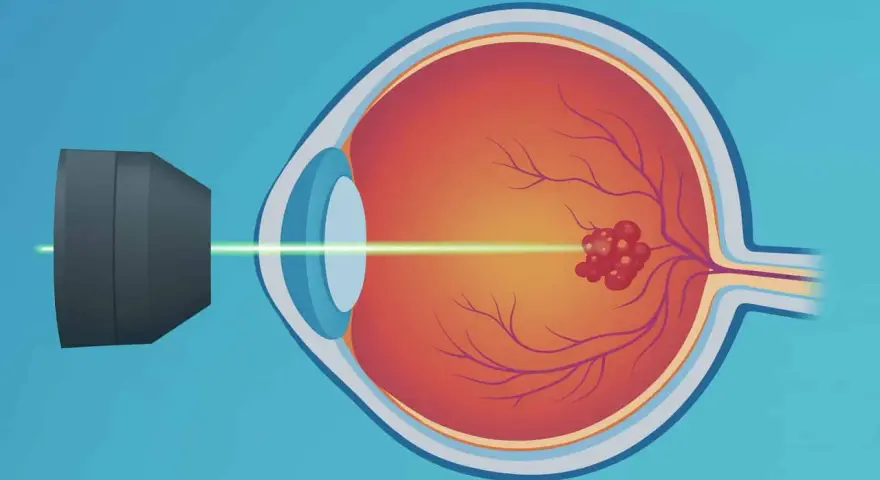 Trattamento con laser per il distacco della retina. Un raggio laser colpisce un'area danneggiata sulla retina.