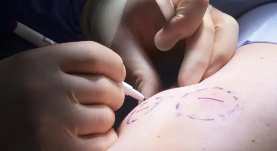 Chirurg markiert mit Stift die Stelle für die Lipomentfernung.