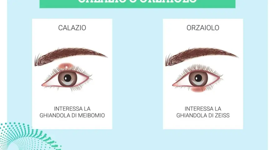 Illustrazione che confronta calazio e orzaiolo. Il calazio interessa la ghiandola di Meibomio, causando un gonfiore.