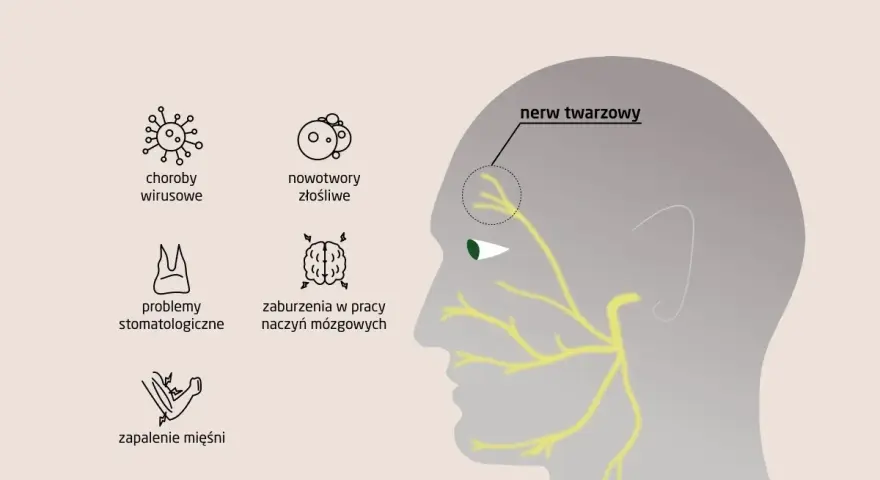 Ilustracja przedstawia przyczyny zapalenia nerwu twarzowego: choroby wirusowe, nowotwory, problemy stomatologiczne, zaburzenia naczyń mózgowych i zapalenie mięśni.