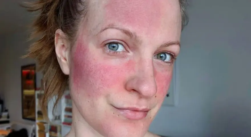 Frau mit stark geröteter Haut im Gesicht, möglicherweise Rosacea. Die Anwendung von Retinol kann hier eine Rolle spielen.