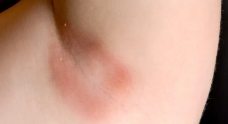Czerwone plamy pod pachami, zaczerwienienie skóry w okolicy pachy, możliwe podrażnienie.