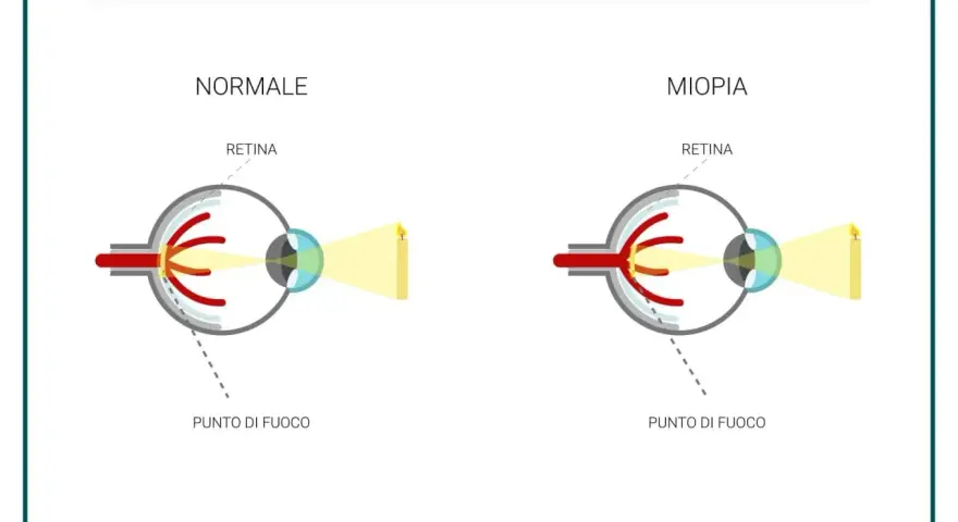 Confronto tra occhio normale e occhio miope: nella miopia, il punto di fuoco cade prima della retina, rendendo la visione sfocata.