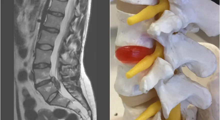 MRI kręgosłupa lędźwiowego i model anatomiczny ukazują ucisk na worek oponowy, który może powodować objawy neurologiczne.