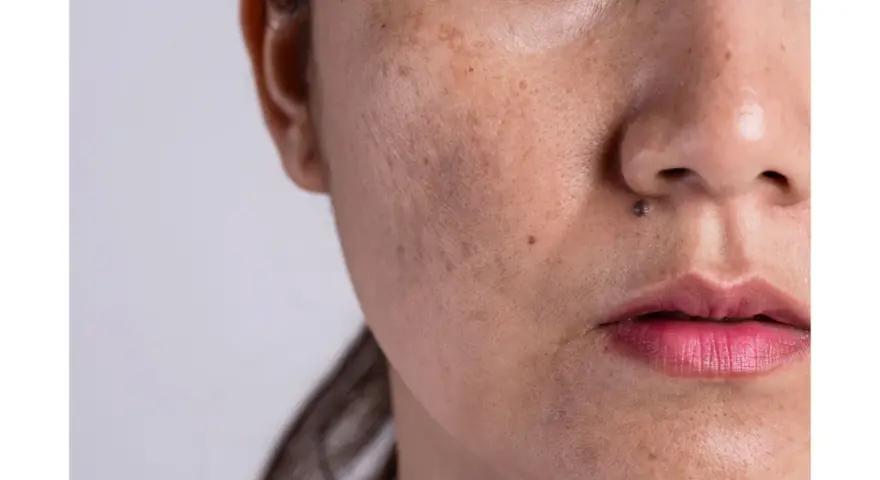 Nahaufnahme eines Gesichts mit sichtbarem Melasma über der Oberlippe und dunklen Flecken.