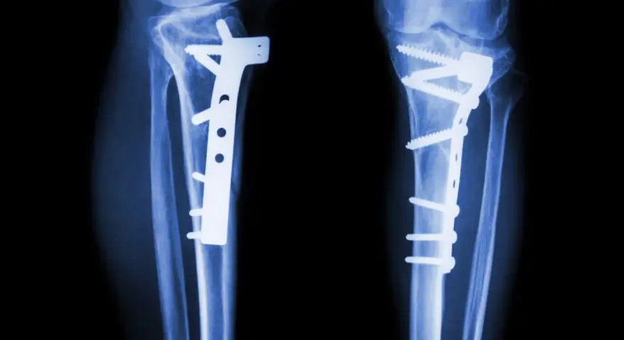 RTG kolan po zabiegu osteotomii guzowatości kości piszczelowej. Widoczne zespolenia płytami i śrubami.