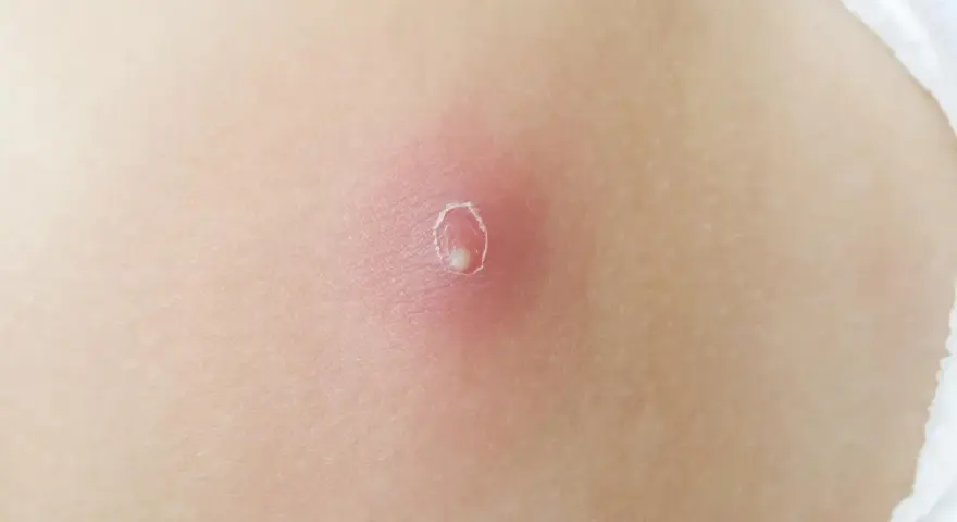 Rote, entzündete Haut mit einem kleinen, weißen Eiterkopf in der Mitte. So sieht ein Abszess aus, wenn er sich bildet.