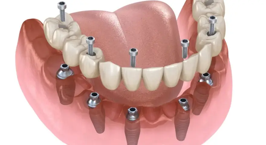 Ile kosztuje implant zęba? Pełny cennik i jak mądrze zaplanować budżet