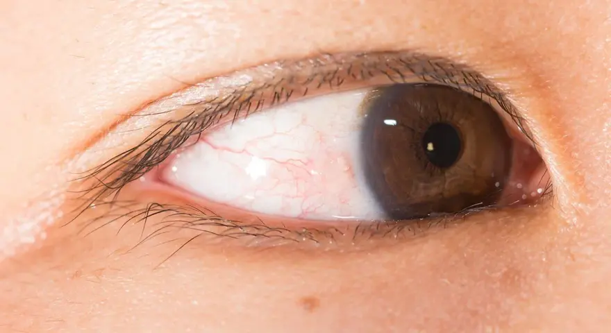 Occhi marroni con sclera arrossata e piccole mosche bianche visibili.