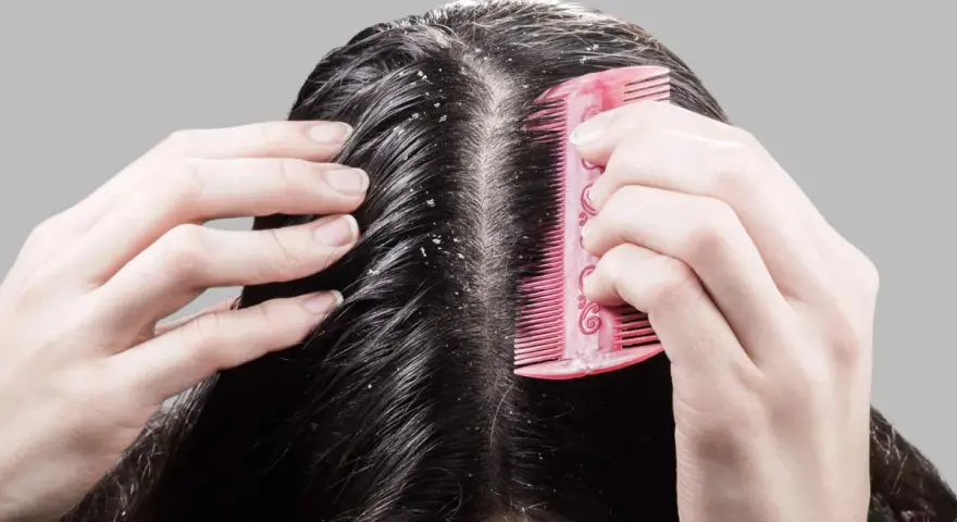 Hände kämmen dunkles Haar, das sichtbare Schuppen zeigt. Die trockene Kopfhaut ist deutlich zu erkennen.