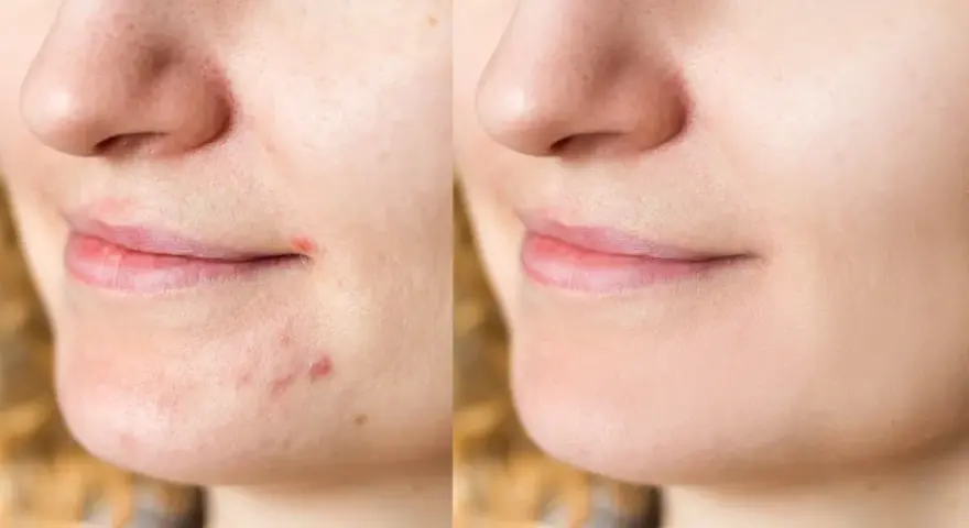 Pasta na pryszcze? Dermatolodzy ODRADZAJĄ! Poznaj fakty i alternatywy