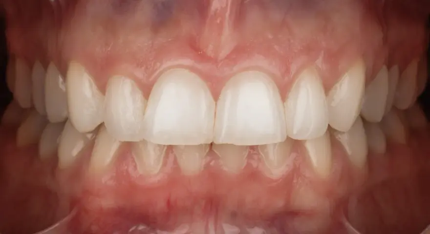 Zbliżenie na zdrowe zęby i dziąsła. Profesjonalna fotografia stomatologiczna ukazująca piękny uśmiech.