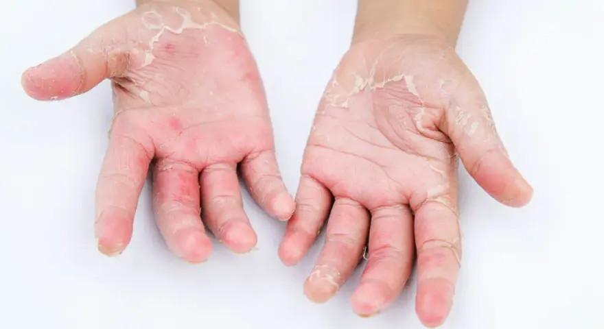 Mani con evidente desquamazione della pelle, arrossamento e secchezza. La pelle appare irritata e screpolata.