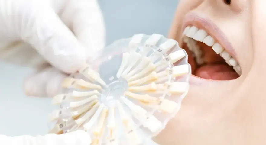 Usta pacjentki z białymi zębami, dentysta porównuje odcień zębów z paletą kolorów. Po wybielaniu zębów zalecana jest biała dieta.