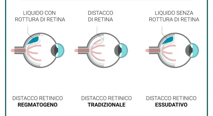 Illustrazione mostra tre tipi di distacco della retina: con rottura, tradizionale e essudativo. Il buco nella retina è evidenziato in uno dei casi.
