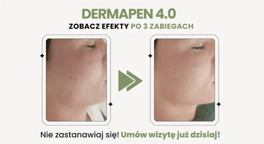Dermapen 4.0 na co? Zobacz efekty po 3 zabiegach: skóra wygładzona, bez niedoskonałości. Umów wizytę!