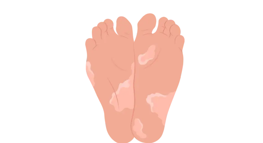 Pieds avec des zones dépigmentées, soulevant la question : pourquoi la peau de mes pieds s'enlève ?