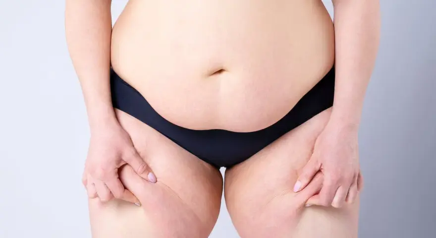 Persona se pellizca la piel de los muslos, mostrando la celulitis. Pensando en ejercicios abdomen bajo para mejorar.